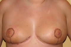 Breast Lift After