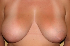 Breast Lift Before